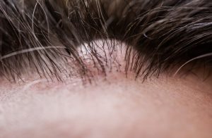 Where Are Sebaceous Cysts Most Commonly Located?