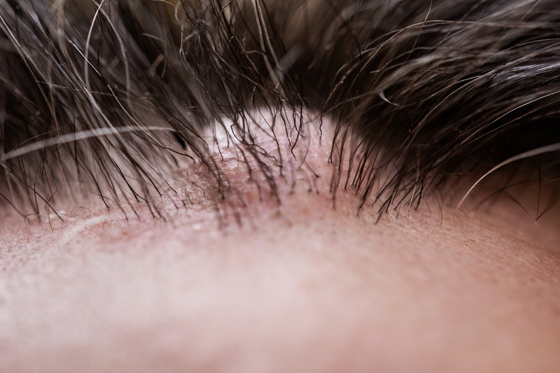 Read more about the article Where Are Sebaceous Cysts Most Commonly Located?