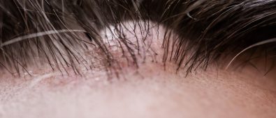 Where Are Sebaceous Cysts Most Commonly Located?